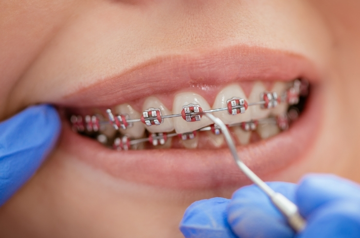 Braces-image.jpg