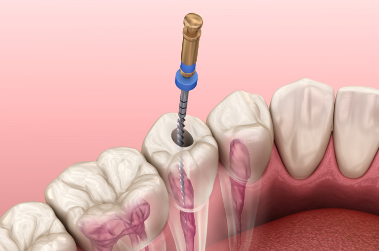 Root canal treatment