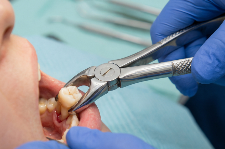 Surgical extraction of tooth (1)